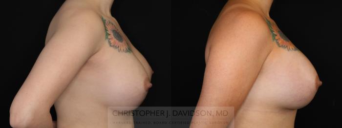 Breast Augmentation Revision Case 492 Before & After Right Side | Boston, MA | Christopher J. Davidson, MD