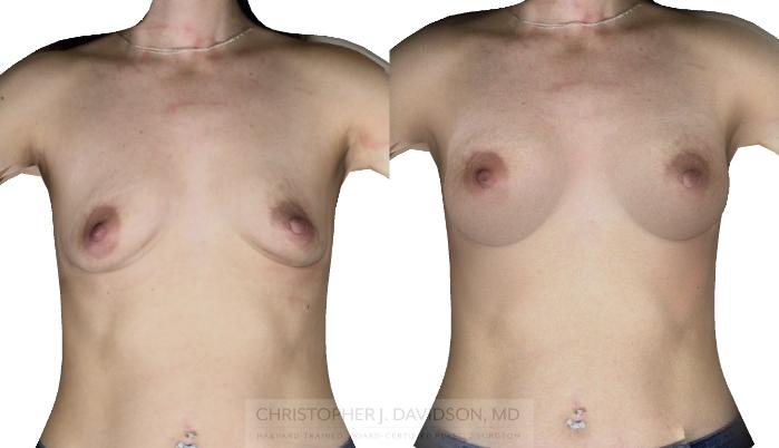 Breast Augmentation with 3D Imaging Case 411 Before & After Front - Crisalix Preview | Boston, MA | Christopher J. Davidson, MD