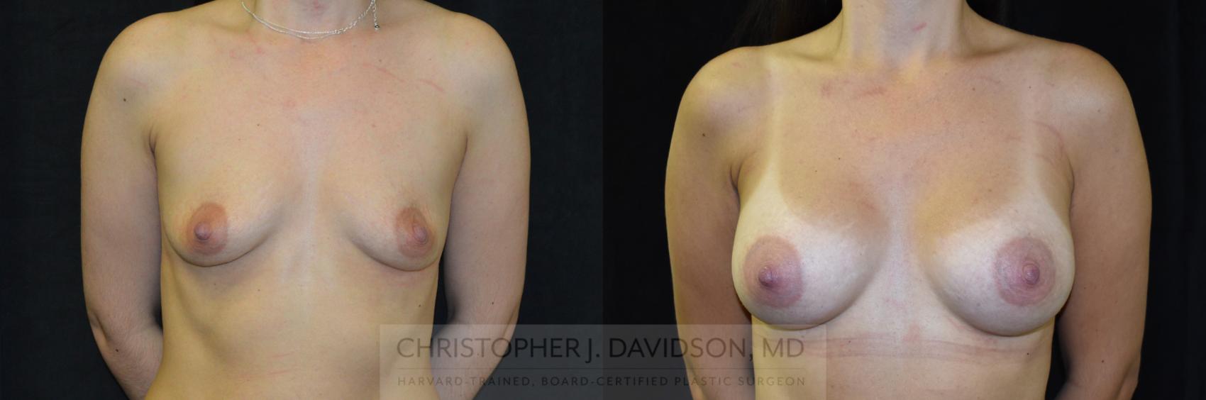 Breast Augmentation with 3D Imaging Case 411 Before & After Front | Boston, MA | Christopher J. Davidson, MD
