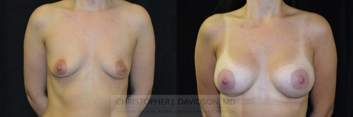 Breast Augmentation with 3D Imaging Case 411 Before & After Front | Boston, MA | Christopher J. Davidson, MD