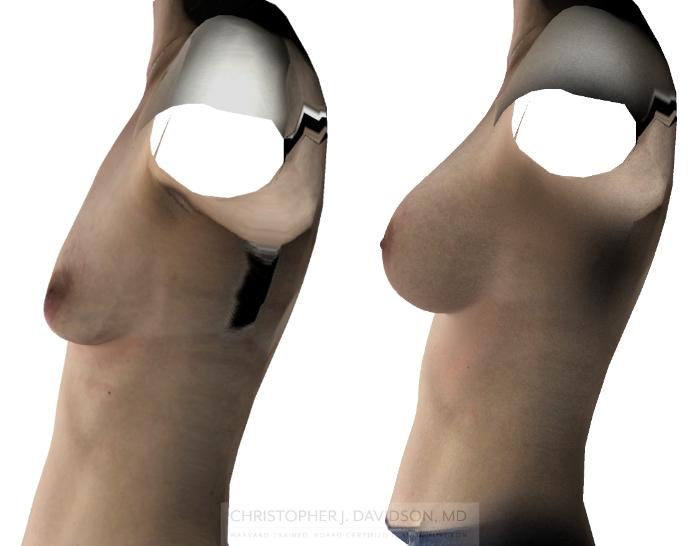 Breast Augmentation with 3D Imaging Case 411 Before & After Left Side - Crisalix Preview | Boston, MA | Christopher J. Davidson, MD