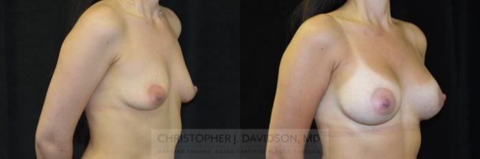 Breast Augmentation with 3D Imaging Case 411 Before & After Right Oblique | Boston, MA | Christopher J. Davidson, MD