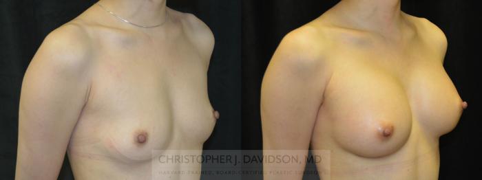 Breast Augmentation Case 127 Before & After View #2 | Boston, MA | Christopher J. Davidson, MD
