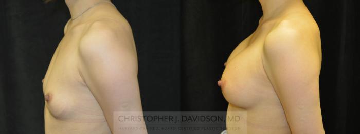 Breast Augmentation Case 127 Before & After View #4 | Boston, MA | Christopher J. Davidson, MD