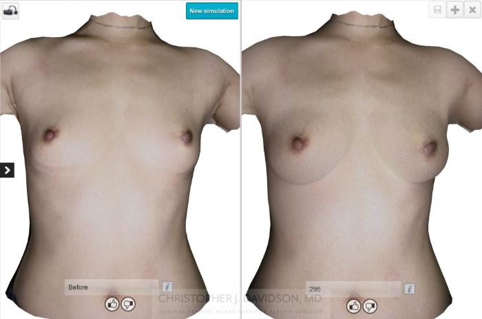 Breast Augmentation with Crisalix Preview Case 127 Before & After View #5 | Boston, MA | Christopher J. Davidson, MD