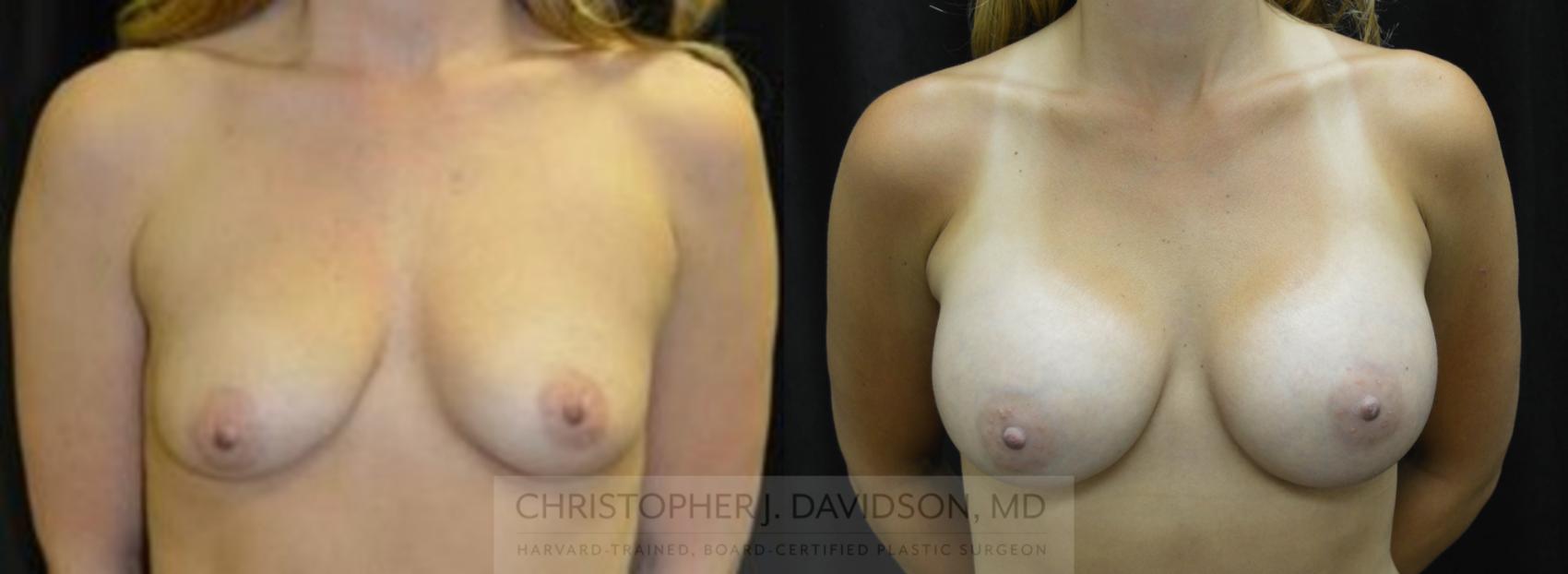 Breast Augmentation Case 17 Before & After View #1 | Boston, MA | Christopher J. Davidson, MD