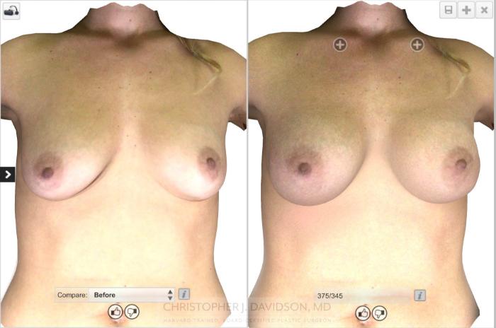 Breast Augmentation with Crisalix Preview Case 17 Before & After View #4 | Boston, MA | Christopher J. Davidson, MD