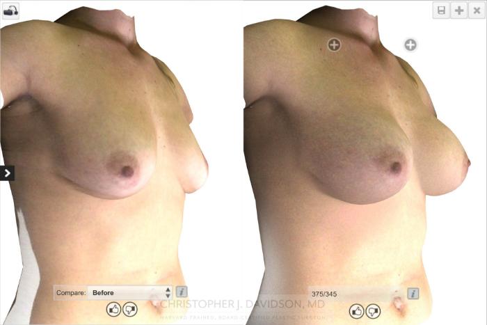 Breast Augmentation with Crisalix Preview Case 17 Before & After View #5 | Boston, MA | Christopher J. Davidson, MD