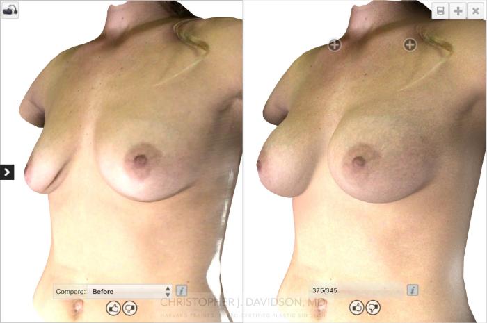 Breast Augmentation Case 17 Before & After View #6 | Boston, MA | Christopher J. Davidson, MD