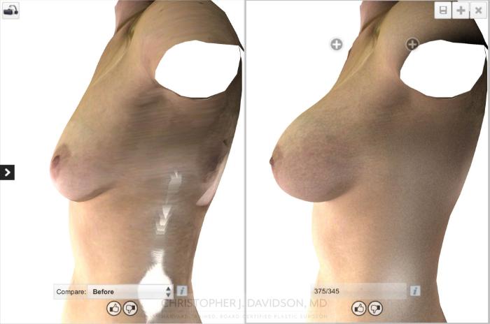 Breast Augmentation with Crisalix Preview Case 17 Before & After View #7 | Boston, MA | Christopher J. Davidson, MD