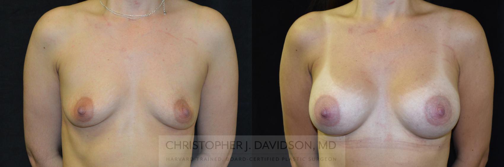 Breast Augmentation Case 250 Before & After View #1 | Boston, MA | Christopher J. Davidson, MD