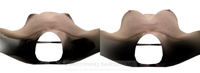 Breast Augmentation with Crisalix Preview Case 250 Before & After View #11 | Boston, MA | Christopher J. Davidson, MD