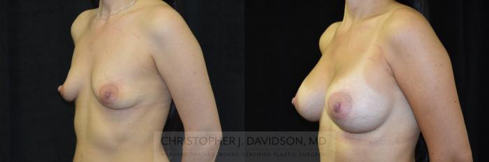 Breast Augmentation Case 250 Before & After View #4 | Boston, MA | Christopher J. Davidson, MD