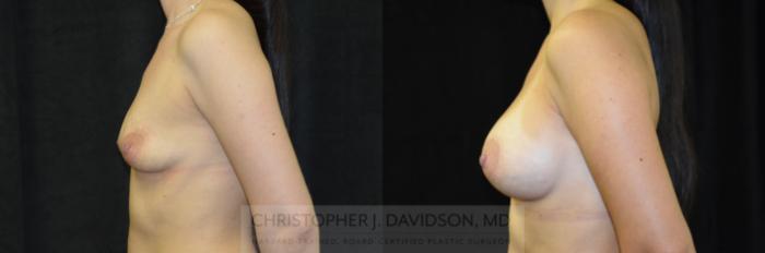 Breast Augmentation Case 250 Before & After View #5 | Boston, MA | Christopher J. Davidson, MD