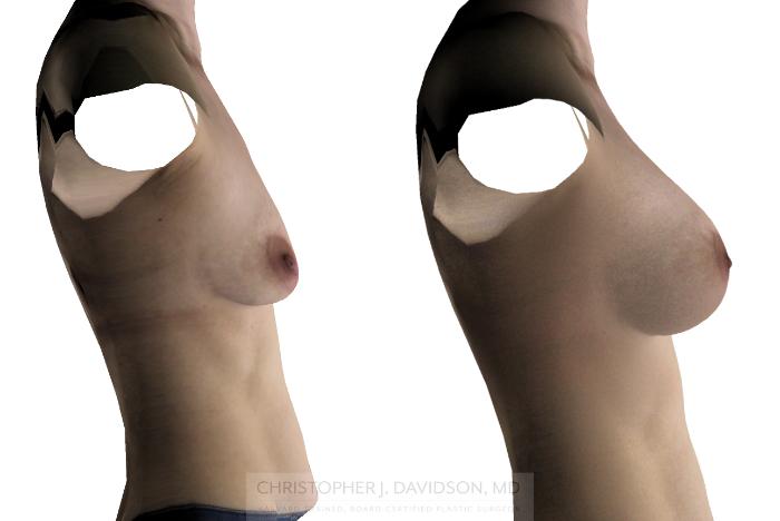 Breast Augmentation Case 250 Before & After View #8 | Boston, MA | Christopher J. Davidson, MD