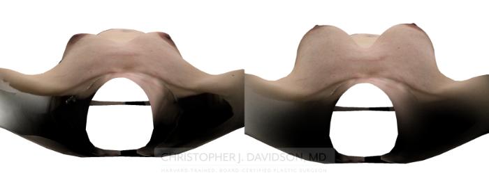 Breast Augmentation with Crisalix Preview Case 411 Before & After Above - Crisalix Preview | Boston, MA | Christopher J. Davidson, MD