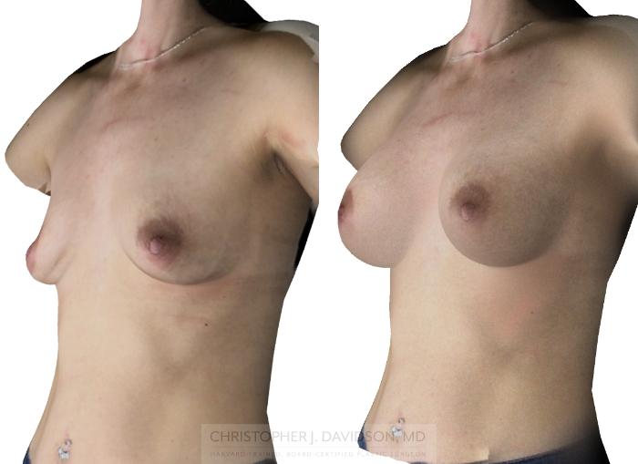 Breast Augmentation with Crisalix Preview Case 411 Before & After Left Oblique - Crisalix Preview | Boston, MA | Christopher J. Davidson, MD