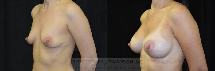 Breast Augmentation with Crisalix Preview Case 411 Before & After Left Oblique | Boston, MA | Christopher J. Davidson, MD