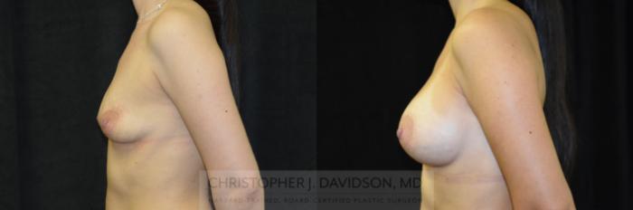 Breast Augmentation with Crisalix Preview Case 411 Before & After Left Side | Boston, MA | Christopher J. Davidson, MD