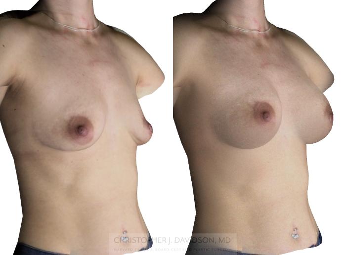 Breast Augmentation with Crisalix Preview Case 411 Before & After Right Oblique - Crisalix Preview | Boston, MA | Christopher J. Davidson, MD