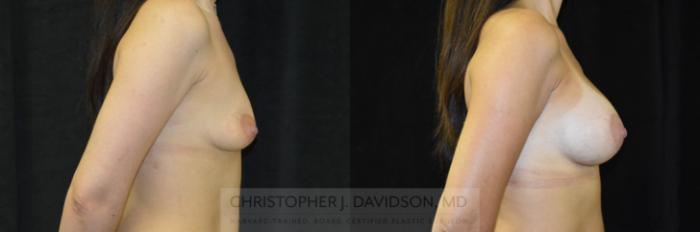 Breast Augmentation with Crisalix Preview Case 411 Before & After Right Side | Boston, MA | Christopher J. Davidson, MD