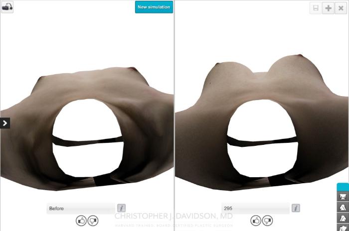 Breast Augmentation with Crisalix Preview Case 412 Before & After Above - Crisalix Preview | Boston, MA | Christopher J. Davidson, MD