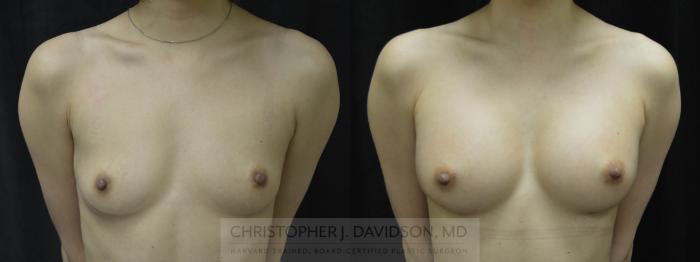 Breast Augmentation with Crisalix Preview Case 412 Before & After Front | Boston, MA | Christopher J. Davidson, MD