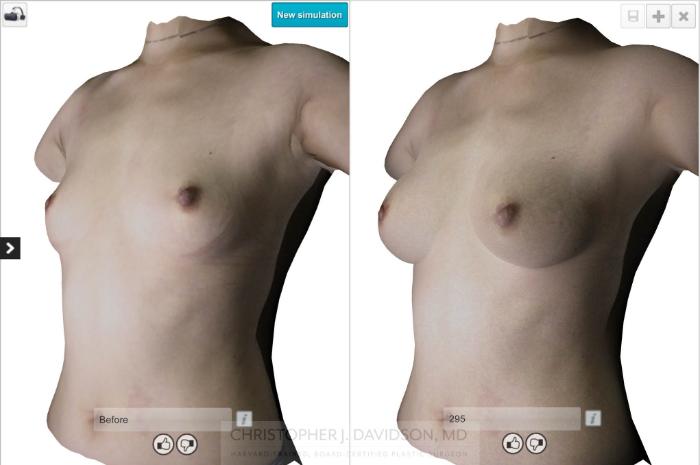 Breast Augmentation with Crisalix Preview Case 412 Before & After Left Oblique - Crisalix Preview | Boston, MA | Christopher J. Davidson, MD