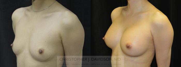 Breast Augmentation with Crisalix Preview Case 412 Before & After Left Oblique | Boston, MA | Christopher J. Davidson, MD