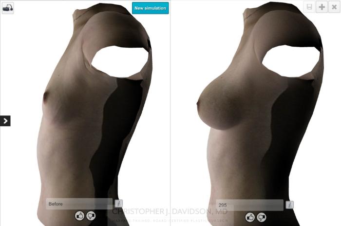 Breast Augmentation with Crisalix Preview Case 412 Before & After Left Side - Crisalix Preview | Boston, MA | Christopher J. Davidson, MD