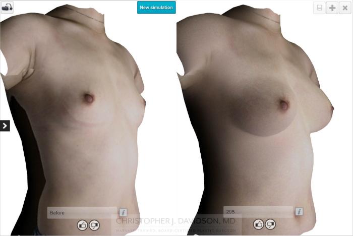 Breast Augmentation with Crisalix Preview Case 412 Before & After Right Oblique - Crisalix Preview | Boston, MA | Christopher J. Davidson, MD