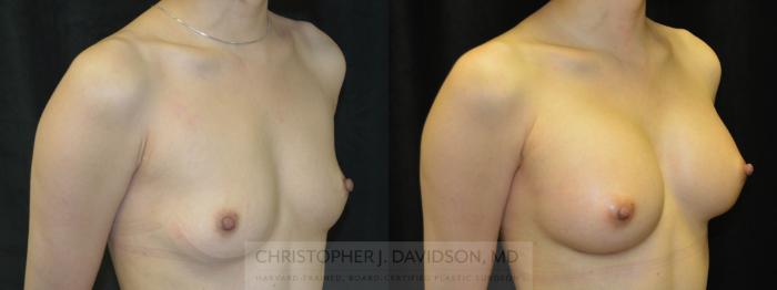 Breast Augmentation with Crisalix Preview Case 412 Before & After Right Oblique | Boston, MA | Christopher J. Davidson, MD