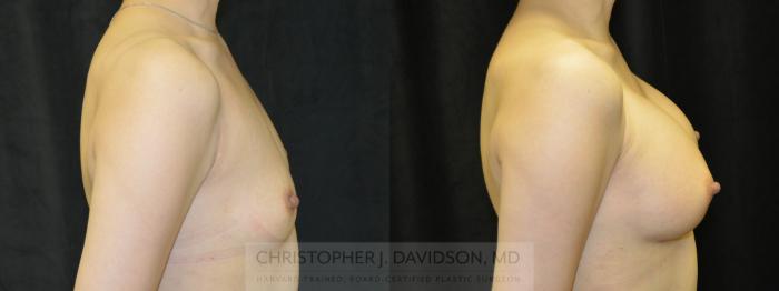 Breast Augmentation with Crisalix Preview Case 412 Before & After Right Side | Boston, MA | Christopher J. Davidson, MD