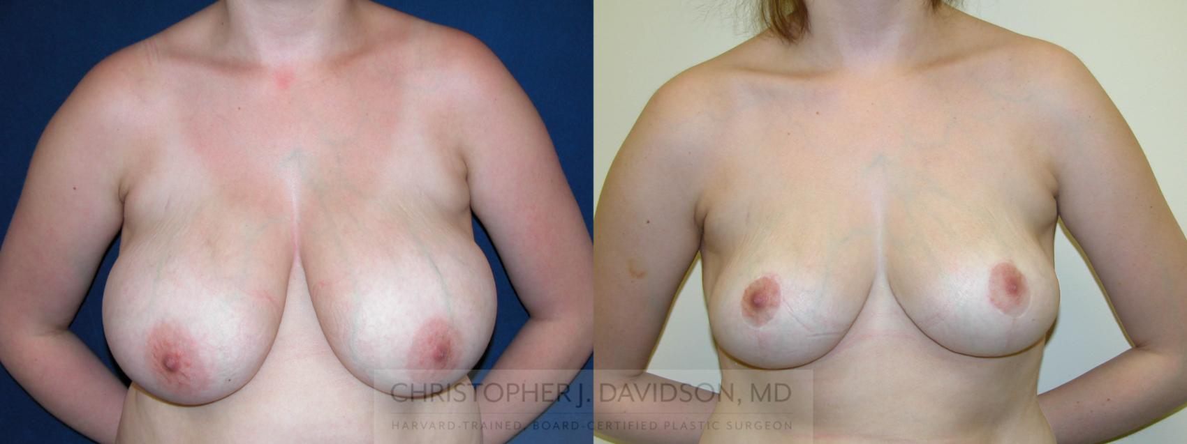 Breast Lift Case 125 Before & After View #1 | Wellesley, MA | Christopher J. Davidson, MD