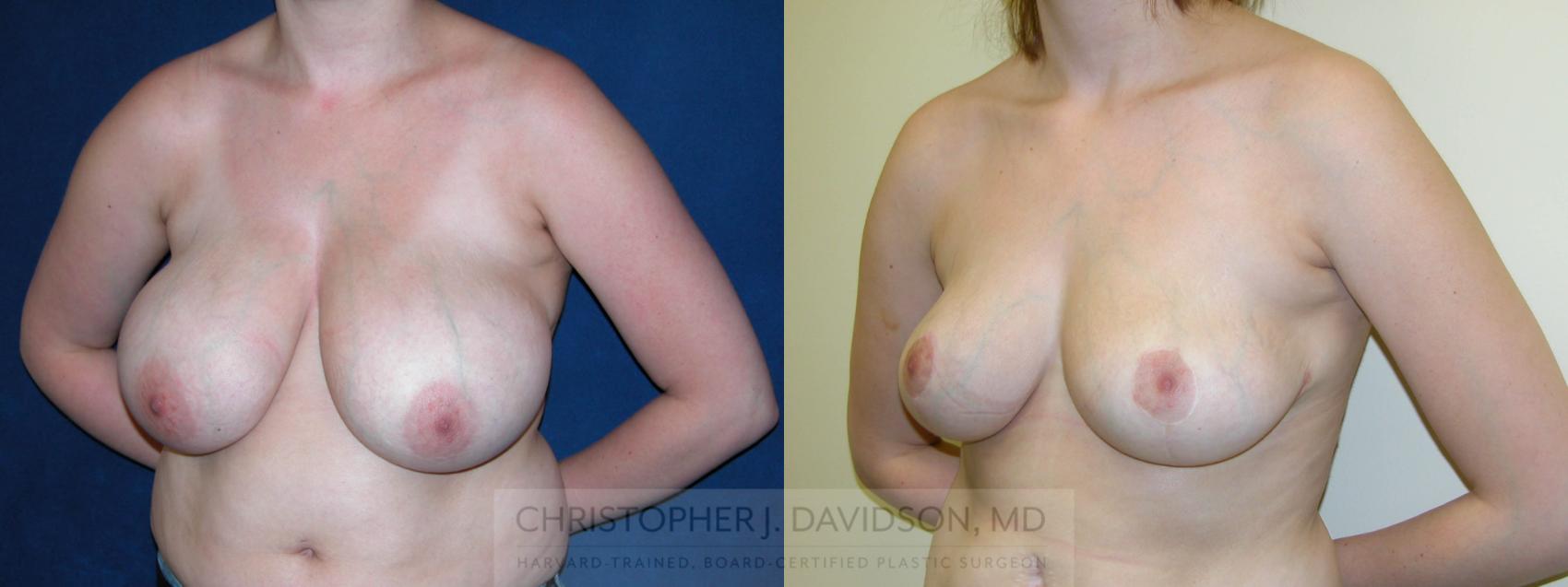 Breast Lift Case 125 Before & After View #2 | Wellesley, MA | Christopher J. Davidson, MD