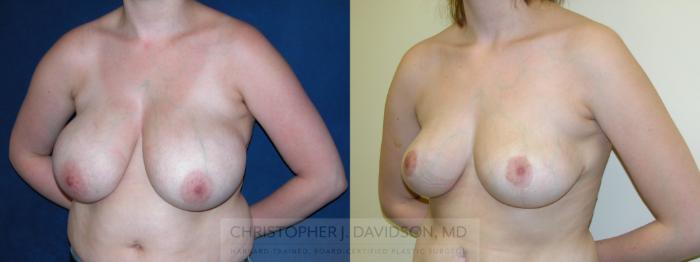 Breast Lift Case 125 Before & After View #2 | Boston, MA | Christopher J. Davidson, MD