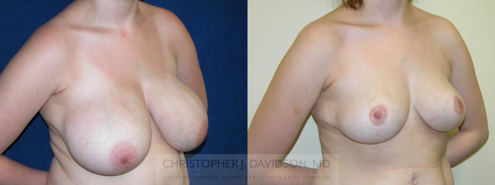 Breast Lift Case 125 Before & After View #3 | Wellesley, MA | Christopher J. Davidson, MD