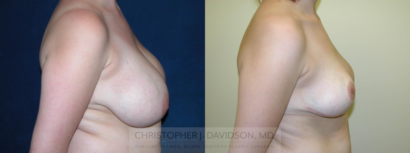 Breast Lift Case 125 Before & After View #4 | Wellesley, MA | Christopher J. Davidson, MD