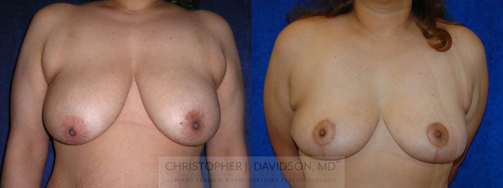 Breast Lift Case 145 Before & After View #1 | Wellesley, MA | Christopher J. Davidson, MD