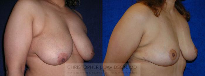 Breast Lift Case 145 Before & After View #2 | Boston, MA | Christopher J. Davidson, MD