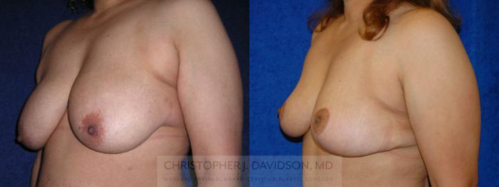 Breast Lift Case 145 Before & After View #3 | Boston, MA | Christopher J. Davidson, MD
