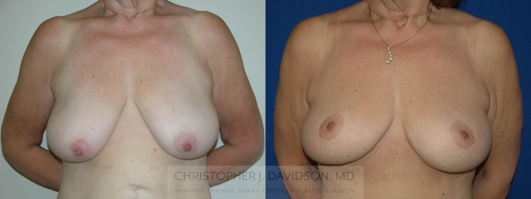 Breast Lift Case 146 Before & After View #1 | Wellesley, MA | Christopher J. Davidson, MD