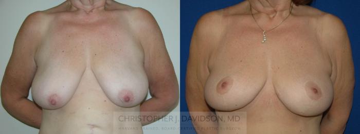 Breast Lift Case 146 Before & After View #1 | Boston, MA | Christopher J. Davidson, MD