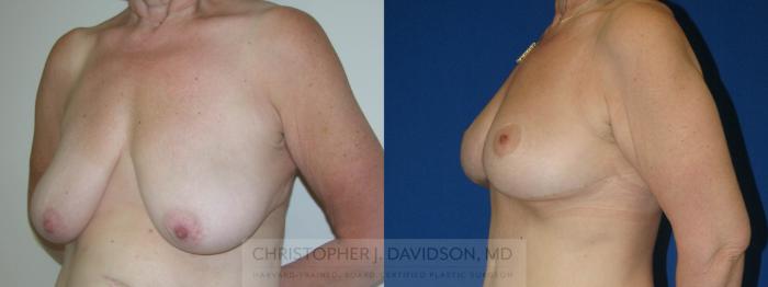 Breast Lift Case 146 Before & After View #2 | Boston, MA | Christopher J. Davidson, MD