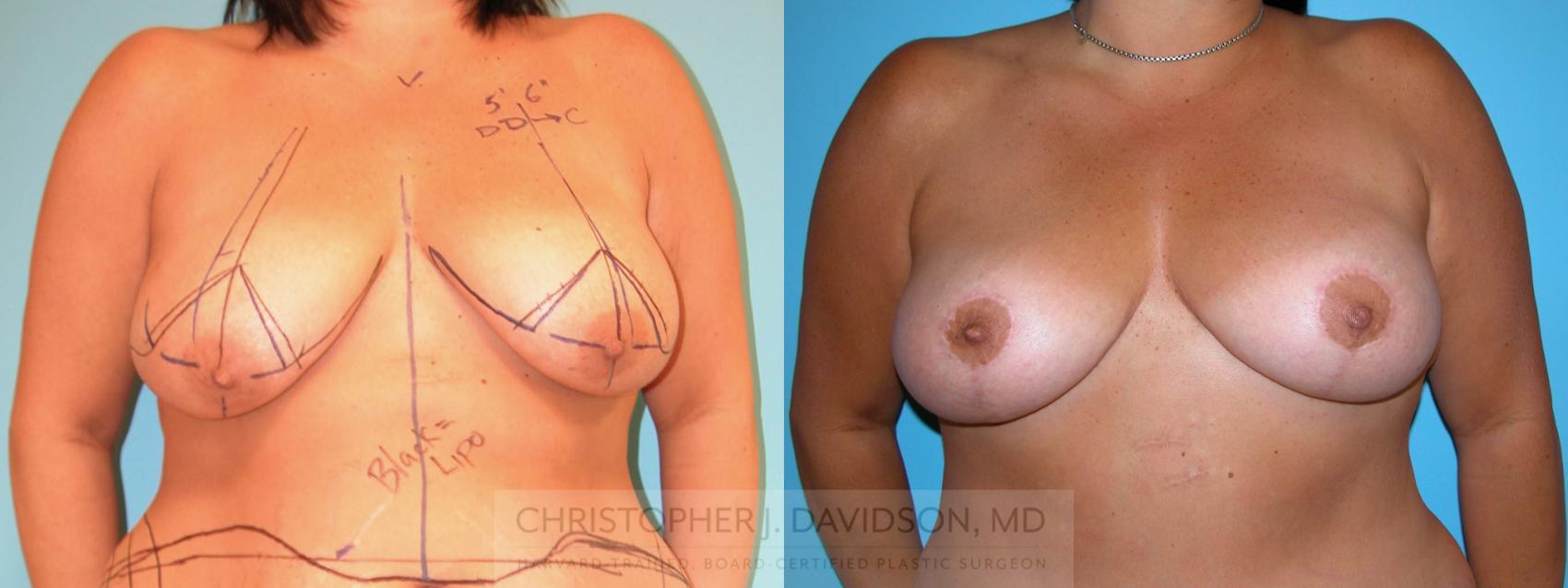 Breast Lift Case 159 Before & After View #1 | Wellesley, MA | Christopher J. Davidson, MD