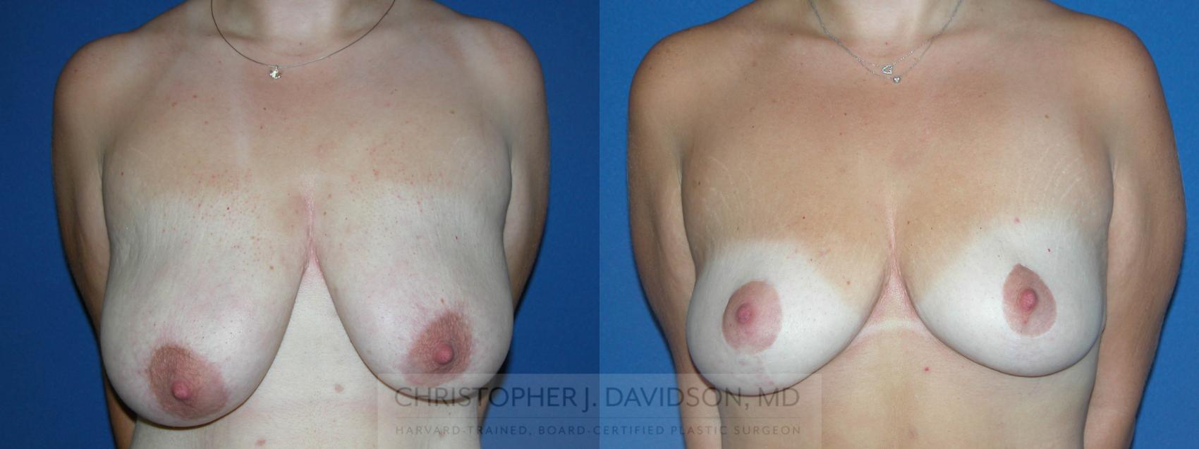 Breast Lift Case 174 Before & After View #1 | Wellesley & Boston, MA | Christopher J. Davidson, MD