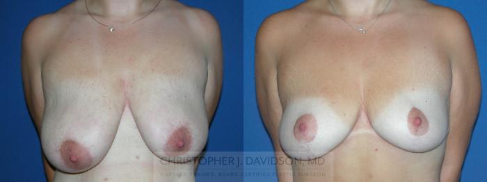 Breast Lift Case 174 Before & After View #1 | Boston, MA | Christopher J. Davidson, MD