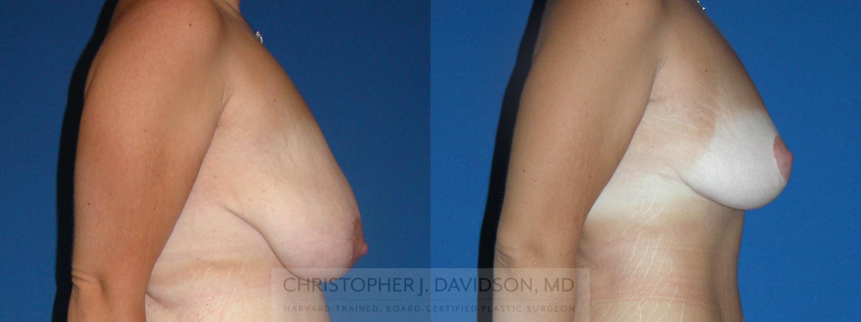 Breast Lift Case 174 Before & After View #2 | Wellesley & Boston, MA | Christopher J. Davidson, MD