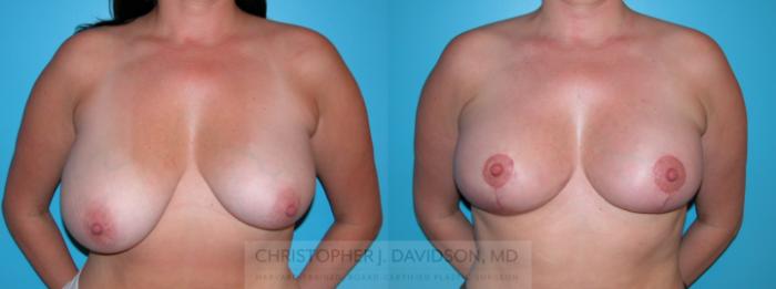 Breast Lift Case 194 Before & After View #1 | Boston, MA | Christopher J. Davidson, MD