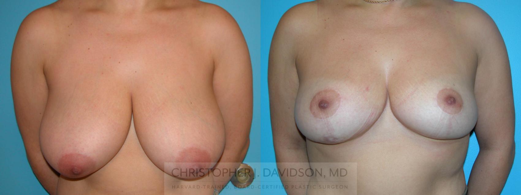 Breast Lift Case 200 Before & After View #1 | Wellesley, MA | Christopher J. Davidson, MD